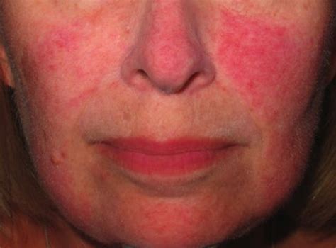 blotchy skin laser treatments  redness pigmentation sydney