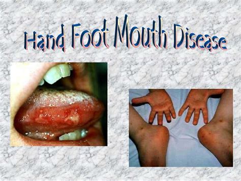 Ppt Hand Foot Mouth Disease Powerpoint Presentation