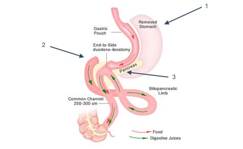Bariatric Surgery Procedures Asmbs