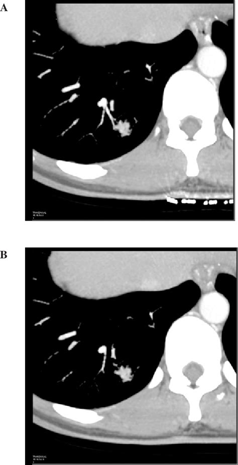 Figure 2 From A Case Of Pulmonary Sclerosing Hemangioma With Low 18