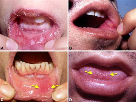 oral mucosal fixed drug eruption characteristics  differential