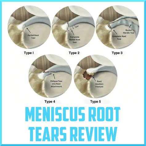 assessment  meniscus root tears foppacasa