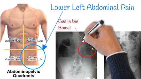 pain   left abdomen  stomach pain  common  youtube