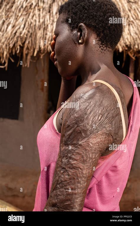 african woman burn victim covers  face  showing scars