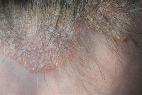 skin diseases  hair loss
