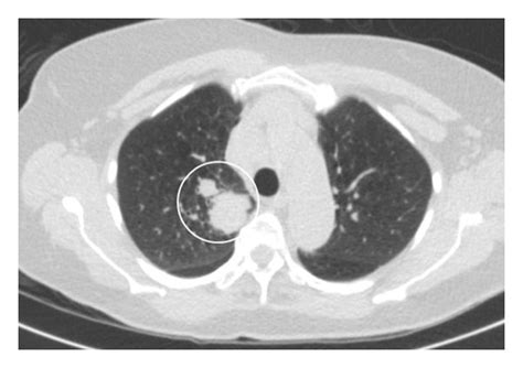 Ct Scan Of The Chest Showing A 4 2 Cm Lobulated Pleuralbased Mass In
