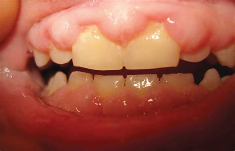 gingival hypertrophy  symptoms diagnosis treatment