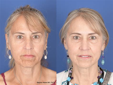 Rhinoplasty Before And After 93 Weber Facial Plastic Surgery
