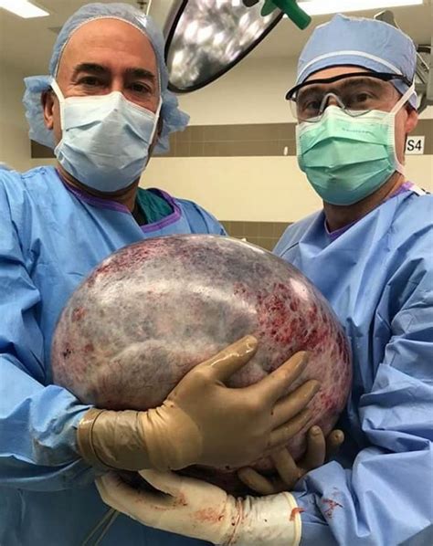 an enormous 40 pound 18 kg ovarian cyst medizzy journal