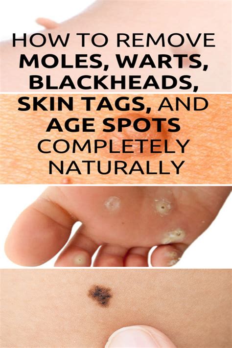 how to remove moles warts blackheads skin tags and age