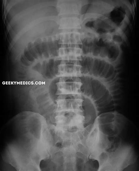 Abdominal X Ray Interpretation Axr Geeky Medics