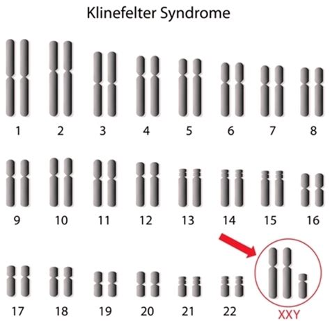 The Health Website Klinefelter Syndrome Xxy