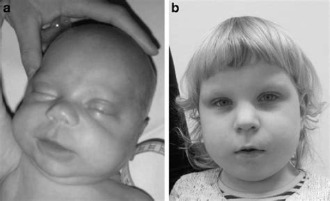 Beckwith Wiedemann Syndrome Tongue