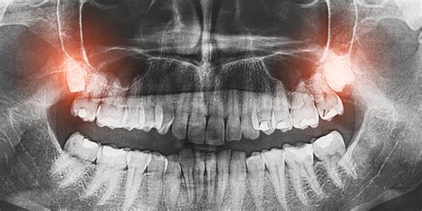 Wisdom Teeth Removal What To Expect Before During And After Self