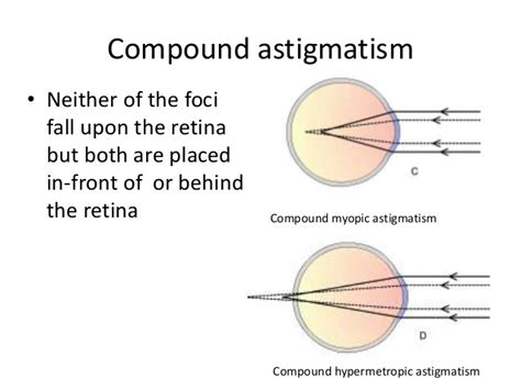 astigmatism vs myopia astigmatism glaucoma swollen eyes