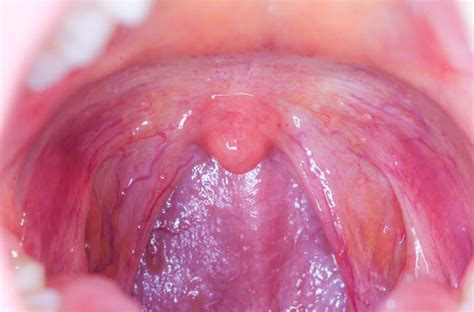 Throat Cancer’s Link To Oral Sex What You Should Know