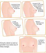 Photos of What Are Signs Of Breast Cancer