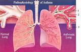 Is Asthma A Chronic Disease Pictures