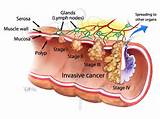 Photos of Colorectal Cancer Stages