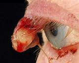 Pictures of Symptoms Of Stye In The Eye