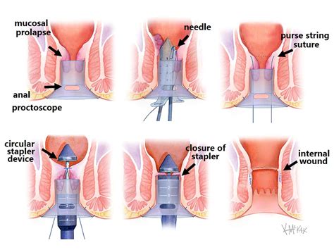 rectal prolapse colorectal surgeons sydney