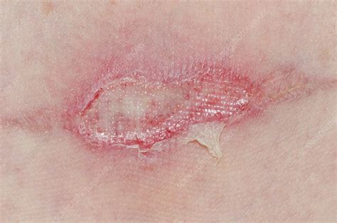 infected burn   skin stock image  science photo library