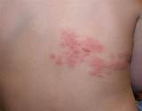 Heat Rash On Back Treatment Photos