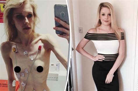 Anorexia Recovery Teen Told She Was Dying Makes Amazing