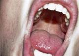 Thrush Of Mouth Symptoms Photos