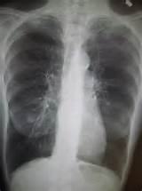 Heart Lung Failure Images