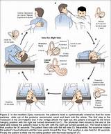 Images of Dizziness Exercises