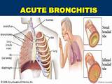 Symptoms Of Bronchitis Images