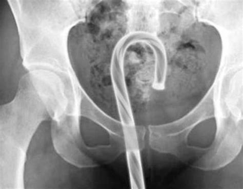 Bizarre Objects Stuck Inside People S Orifices That Required Emergency
