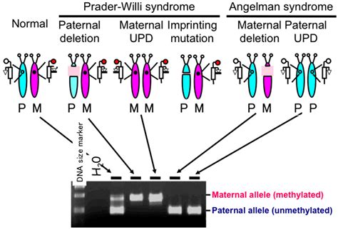 Diseases Free Full Text Prader Willi Syndrome The Disease That