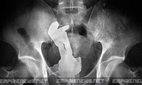 surgeons remove toy from man s rectum for 37th time