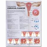 Cervical Cancer Stages Symptoms