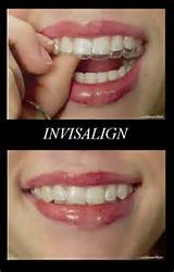 Invisalign Cost Without Insurance Pictures