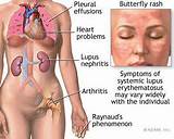 Pictures of About Lupus Symptoms