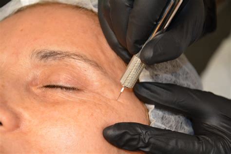 huidtherapie huid en laserkliniek deventer