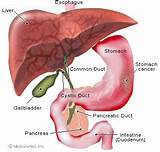 Types Of Stomach Cancer Adenocarcinoma Pictures