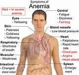 Leukemia Anemia Pictures