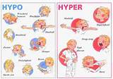 Pictures of Hyperglycemia Symptoms