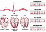 Images of Irregular Heart Beat Symptoms