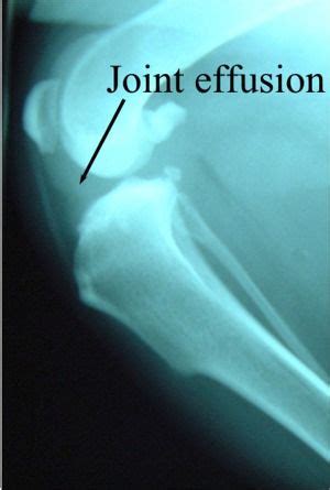joint effusion ligament injury cruciate ligament injury cruciate ligament