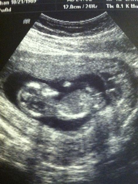 12 week ultrasound any gender guesses based on nub or skull theory