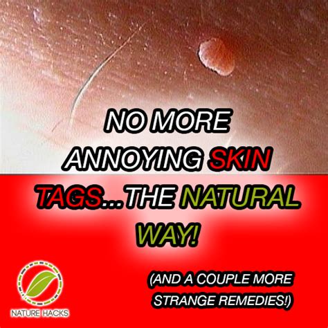 no more annoying skin tags try these natural remedies you probably already have in your home
