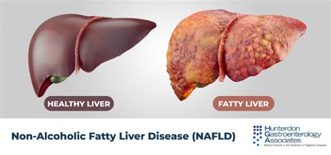 Non Alcoholic Fatty Liver Disease Nafld Hunterdon Gastroenterology
