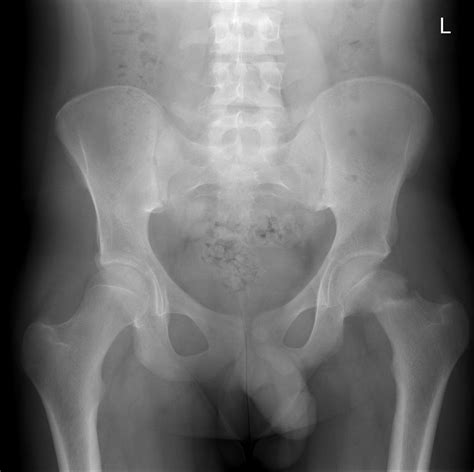 A Rare Case Of A Non Traumatic Neck Of Femur Fracture In A