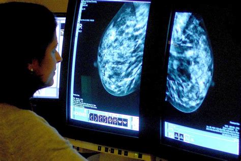 more people could benefit from brca breast cancer drugs