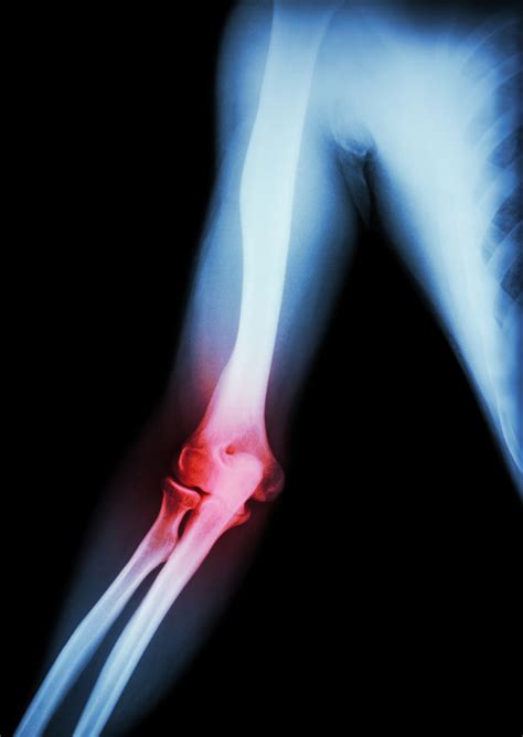 inflammatory arthritis  rock ar ortho arkansas